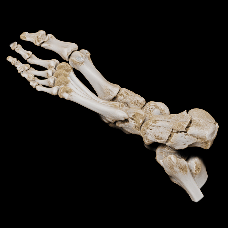 SportsMed Foot CT// Calcaneus fracture