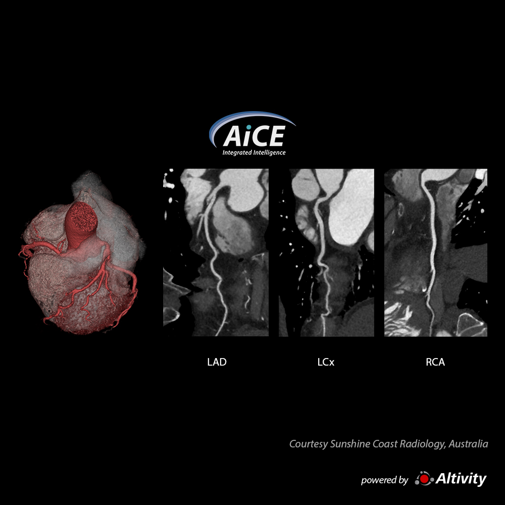 Aquilion Serve SP Cardiac 1.8mSv