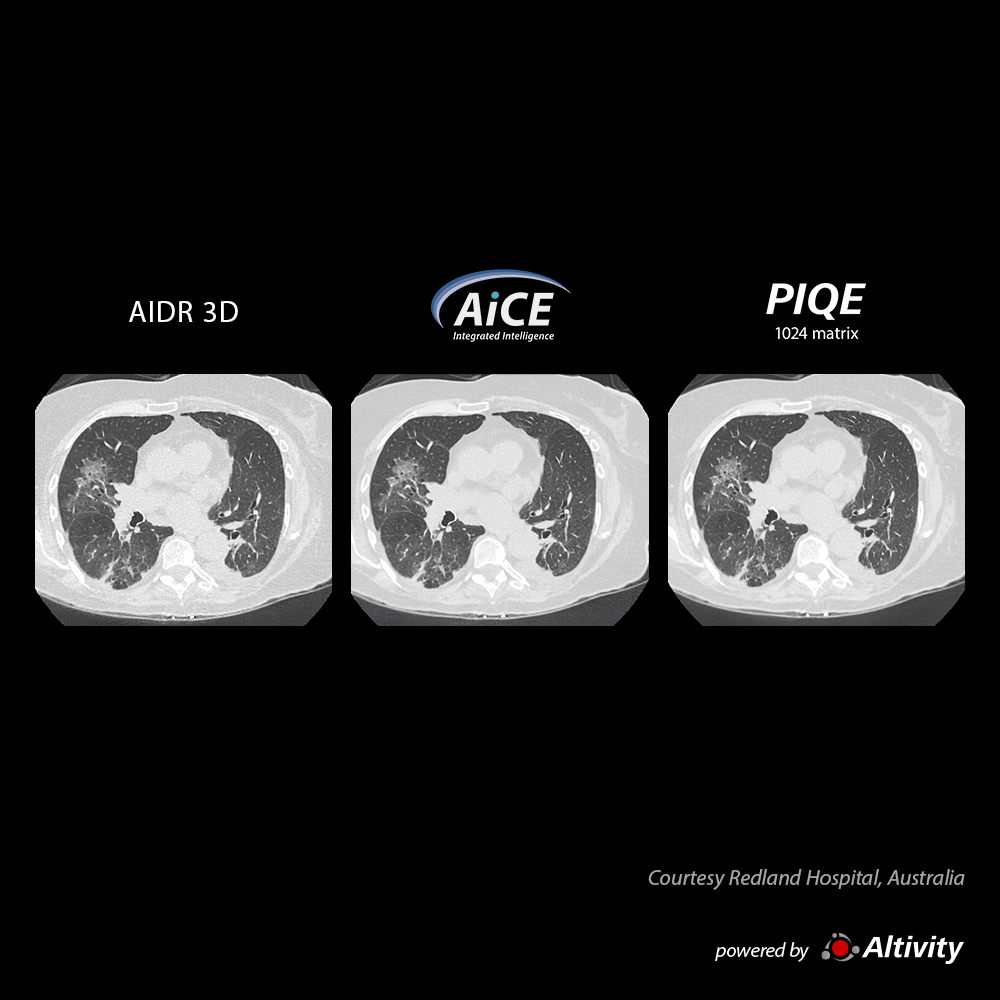 Precise IQ Engine Venous Phase Chest