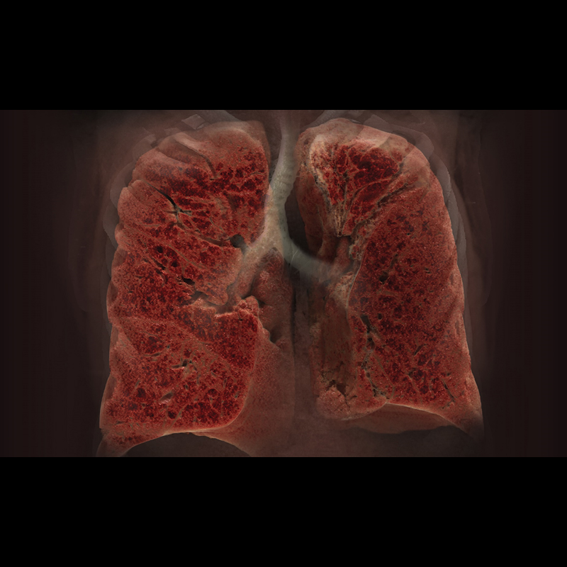 Lung